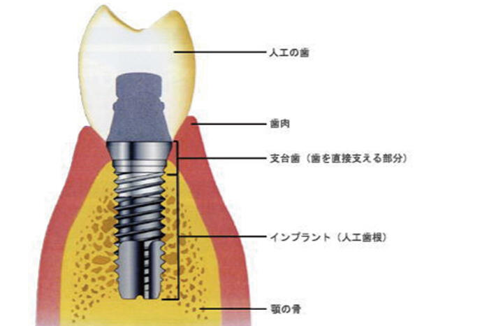 インプラント図解